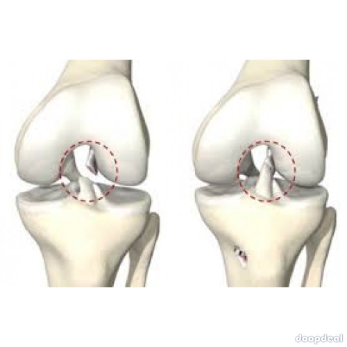 Boost Your Acl Reconstruction Surgery In Navi Mumbai With These Tips